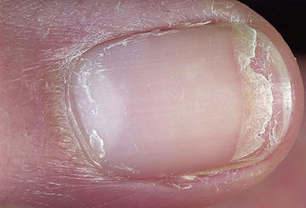 "Đọc" bệnh qua móng tay, Sức khỏe, Mong tay, doc benh, suc khoe, bao phu nu, benh tat,