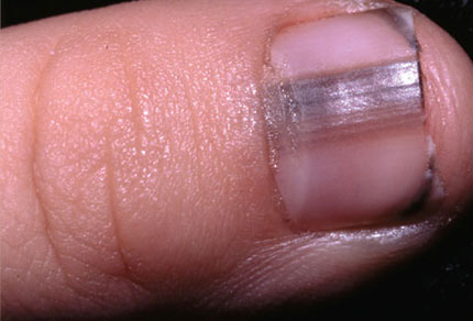 "Đọc" bệnh qua móng tay, Sức khỏe, Mong tay, doc benh, suc khoe, bao phu nu, benh tat,