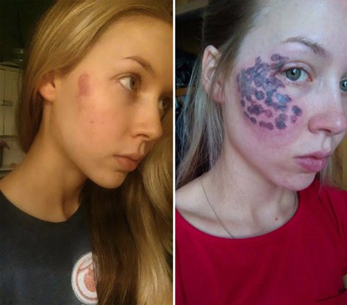xoa vết bớt