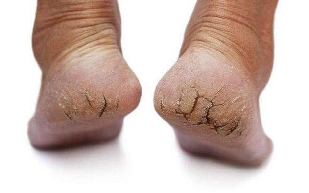 trị nứt gót chân