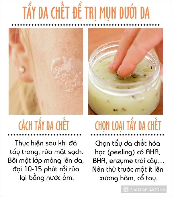 trị mụn