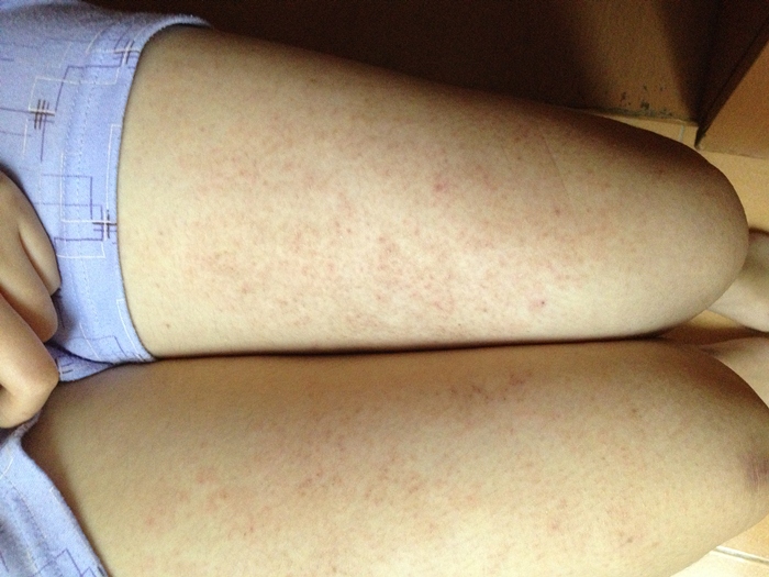 trị viêm lỗ chân lông